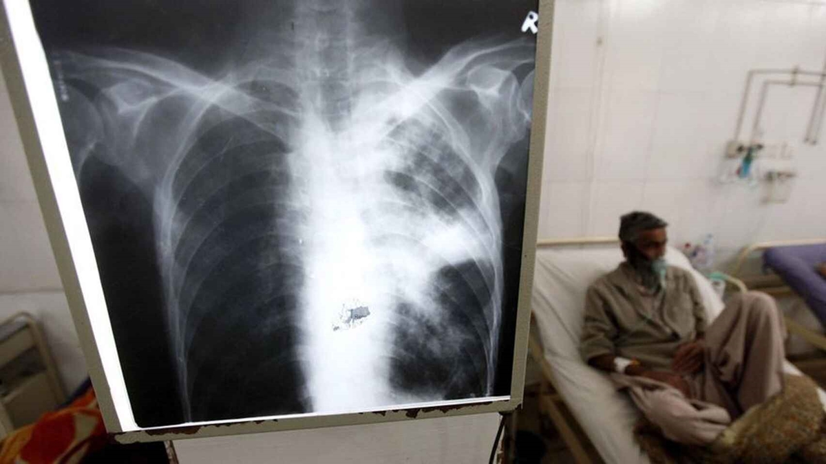 Una radiografía de los pulmones con un enfermo de tuberculosis detrás. EFE