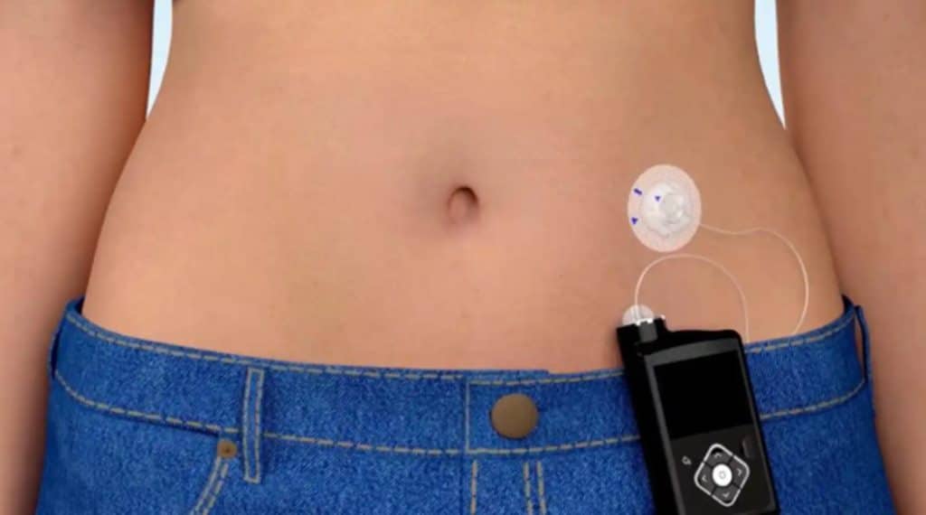 Una paciente con una bomba de insulina