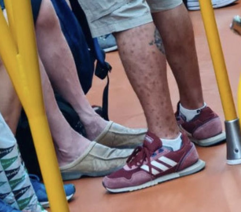 La respuesta a un médico de un hombre que viajaba sabiendo que tenía viruela del mono: “No me toques los…”
