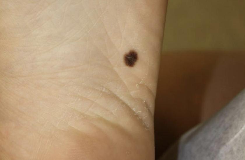6 signos tempranos de melanoma que la mayoría de las personas tienden a ignorar