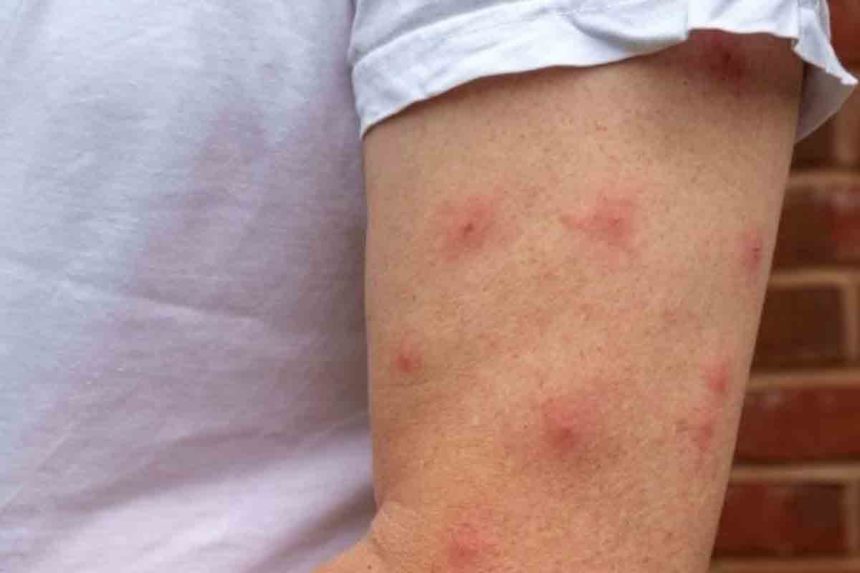 Virus del Nilo occidental salud
